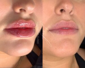 lip fillers results
