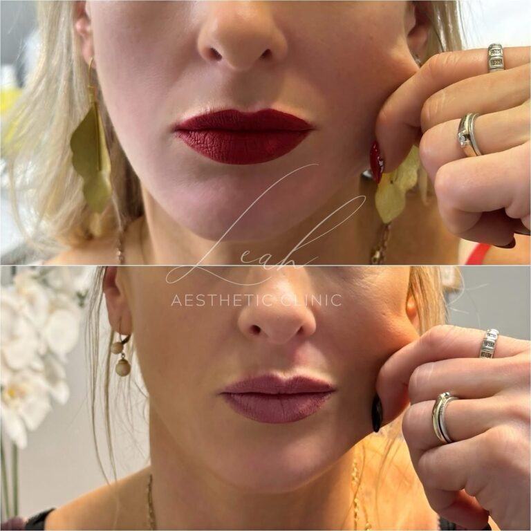 PRP Facial Treatment