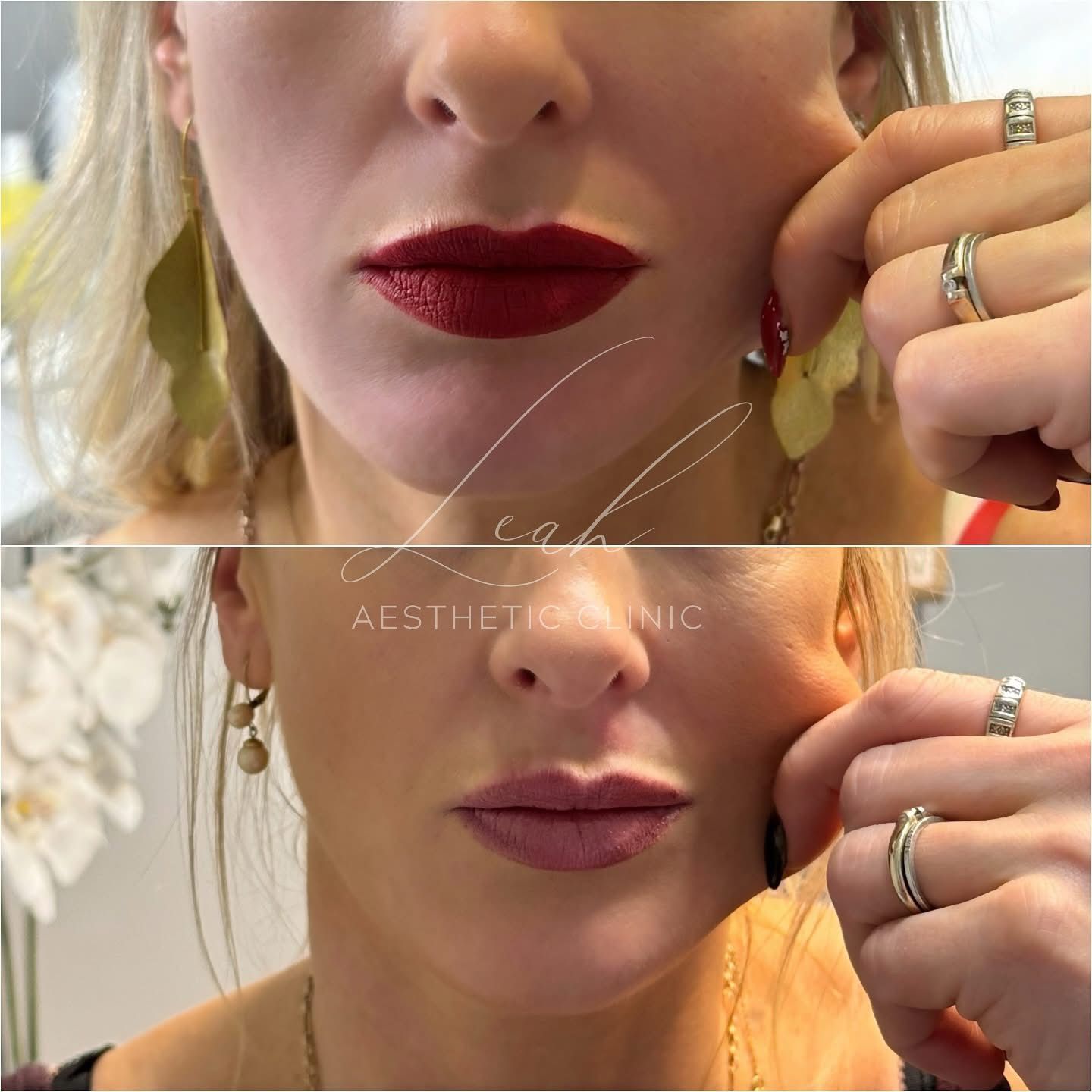 PRP Facial Treatment