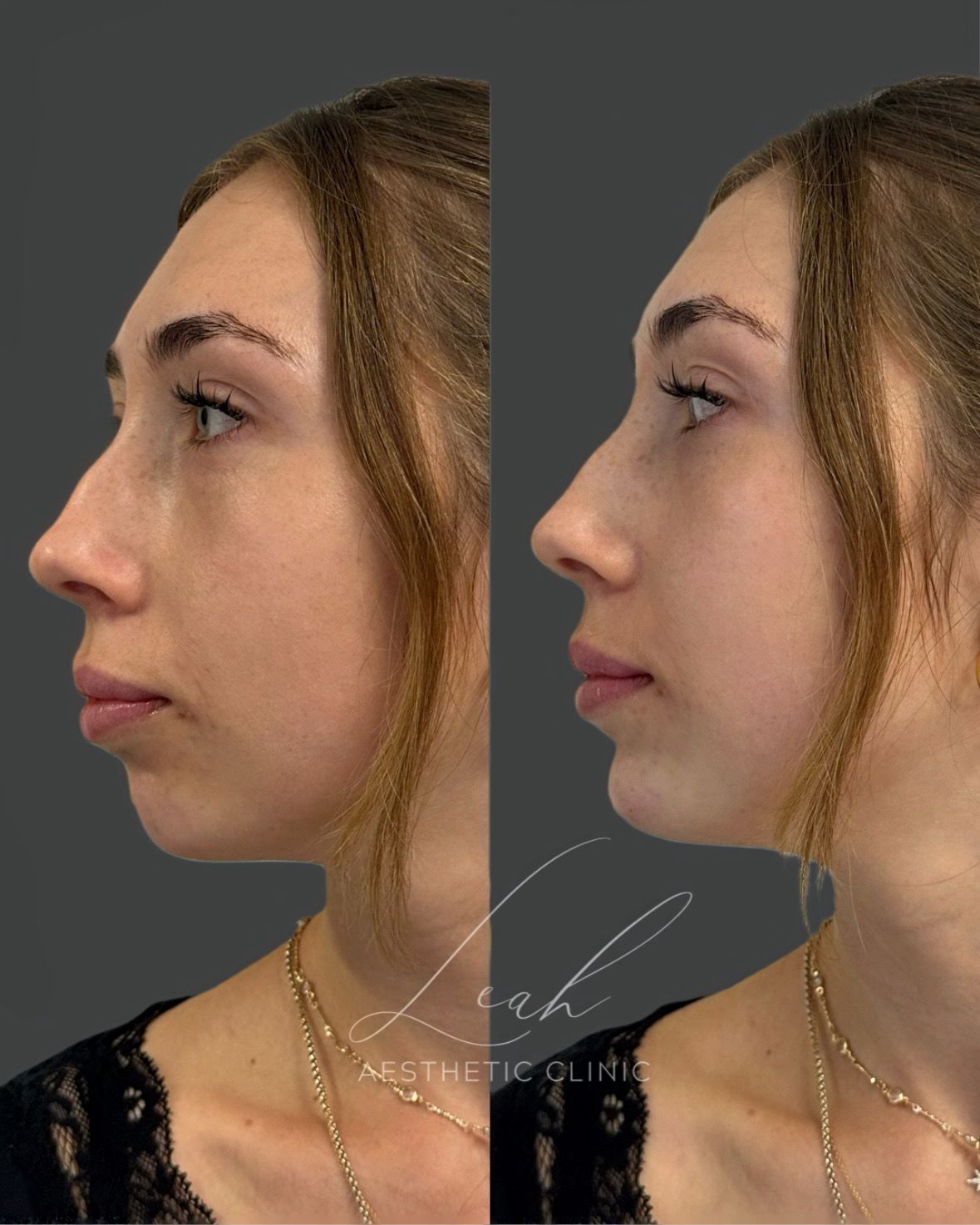 A well-defined chin plays a key role in facial balance and profile harmony. Chin filler is a non-surgical treatment that enhances the lower face, improving proportion and creating a more elegant, confident appearance — without surgery or downtime. Chin filler in Dublin